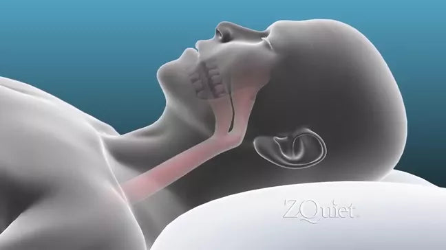 ZQuiet Anti-Snoring Mouthpiece - Firm