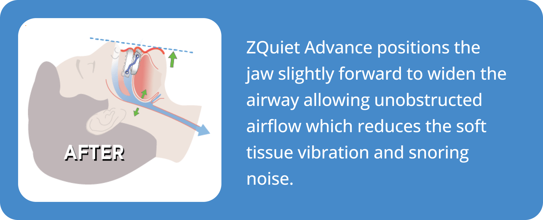 illustration showing how the ZQuiet Advance mouthpiece positions the jaw forward to widen the airway and prevent snoring noises.